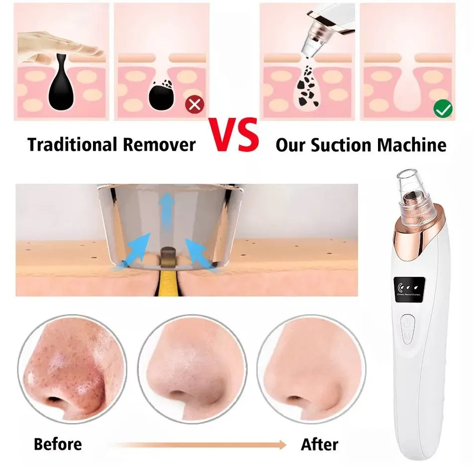 4-in-1 Electric Blackhead Remover- Pore Vacuum Suction Cleaner for Nose & Face